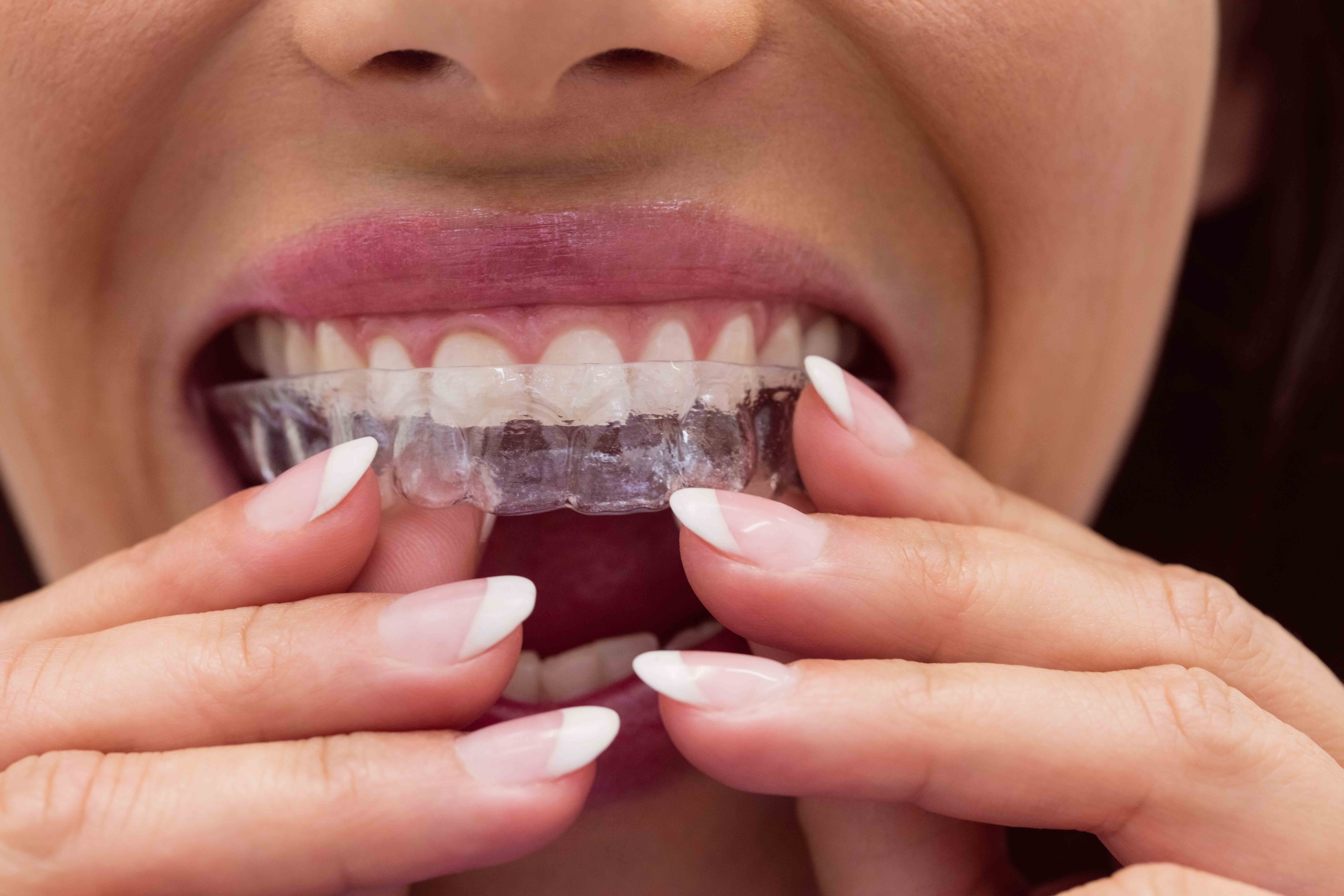 Clear Aligners/ Invisalign